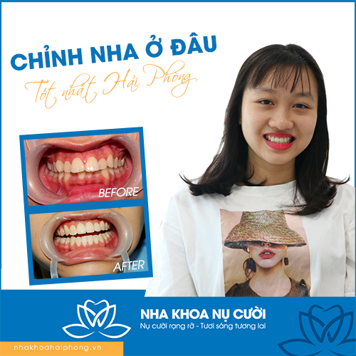 CHỈNH NHA Ở ĐÂU TỐT TẠI HẢI PHÒNG