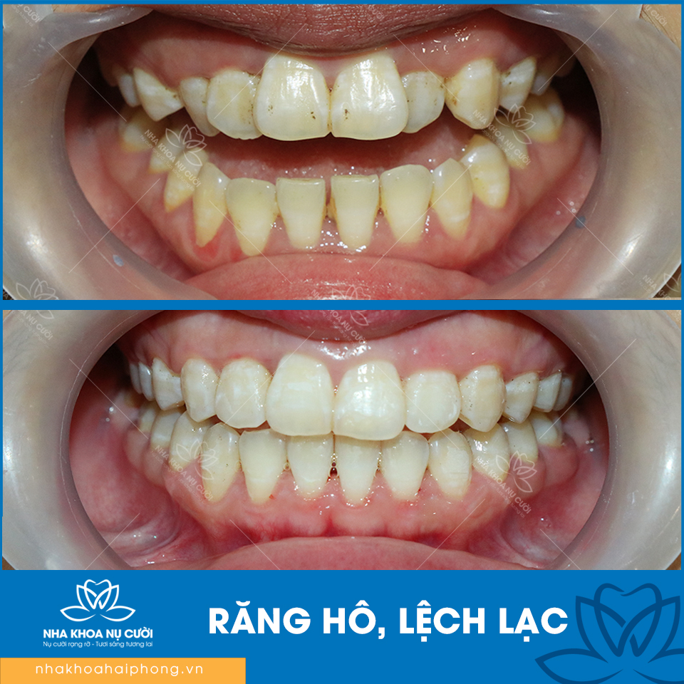 loi-ich-cua-viec-nan-chinh-rang