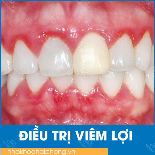 Chữa viêm lợi  –  Nha Khoa Nụ Cười Hải Phòng