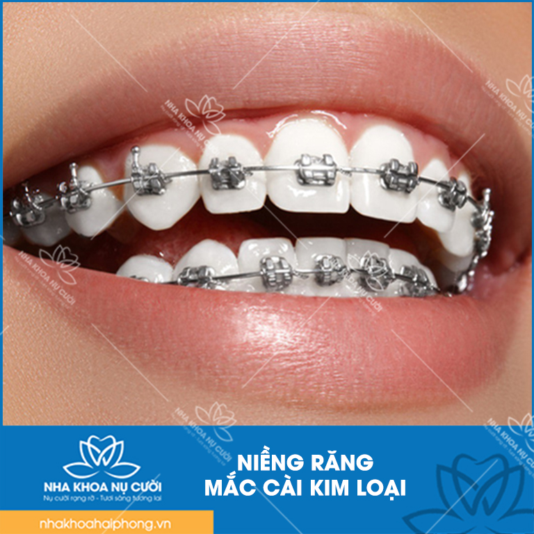 mac-cai-kim-loai
