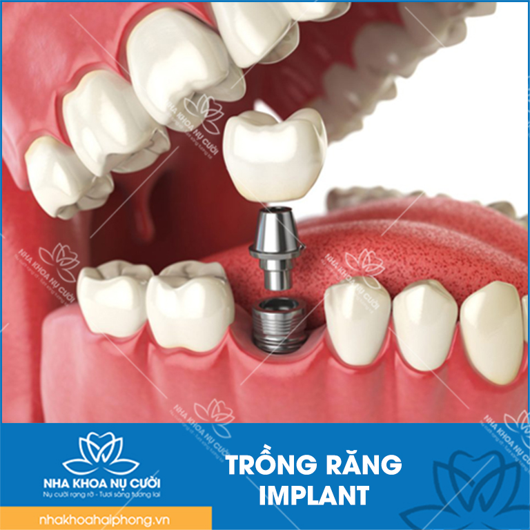 cay-ghep-Implant