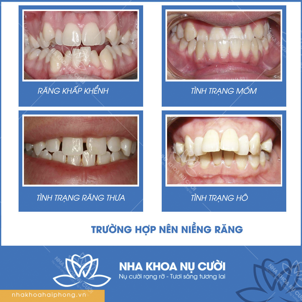 truong-hop-nen-nieng-rang