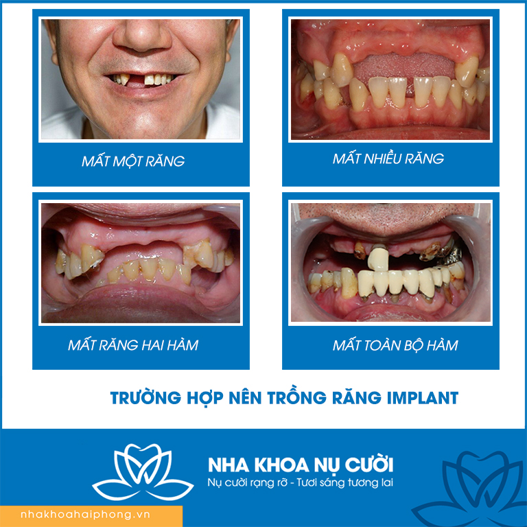 truong-hop-nen-trong-Impalnt