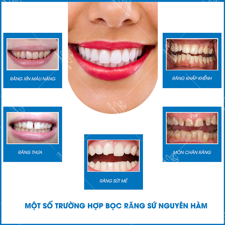 truong-hop-nen-boc-rang-su-nguyen-ham