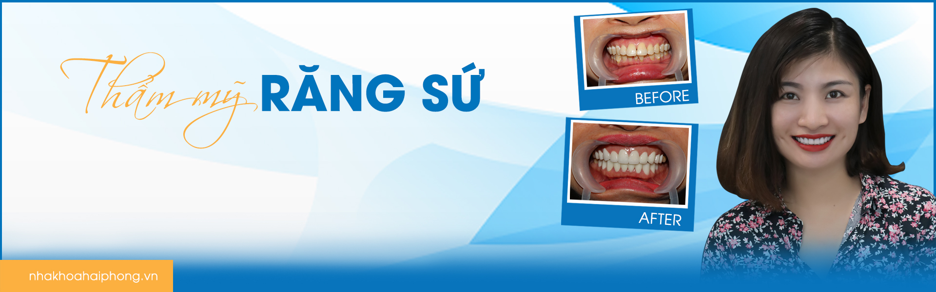 BỌC RĂNG SỨ NGUYÊN HÀM VÀ NHỮNG ĐIỀU BẠN CẦN BIẾT