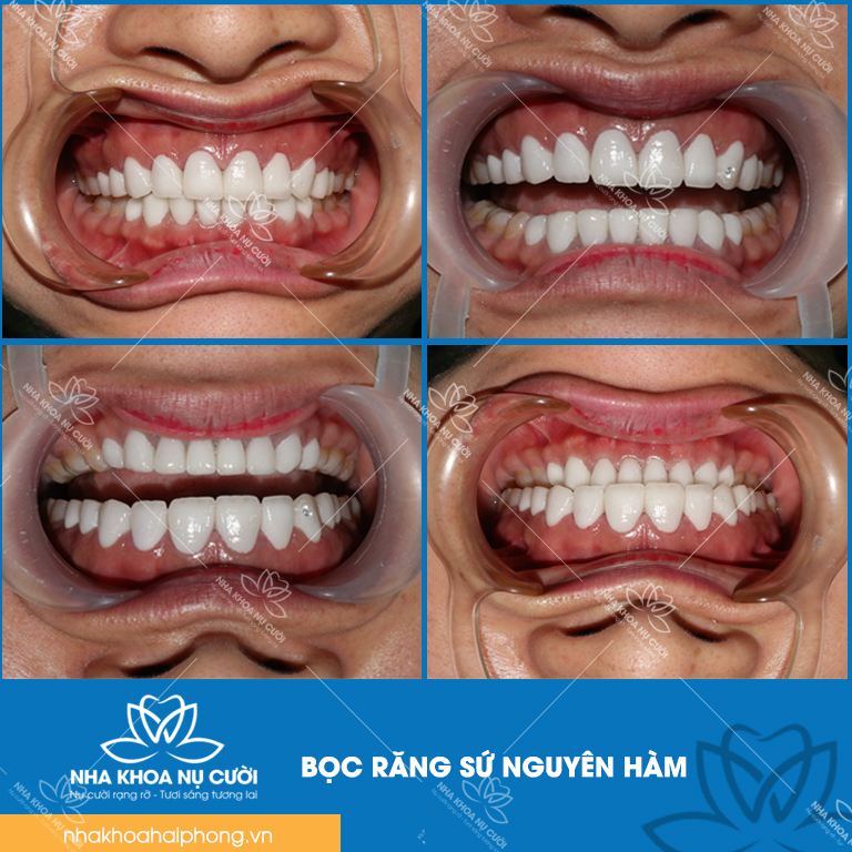 boc-rang-su-nguy-ham-va-nhung-dieu-can-biet