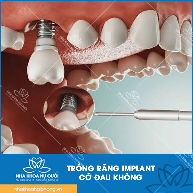 Trong-rang-Implant-c0-dau-khong