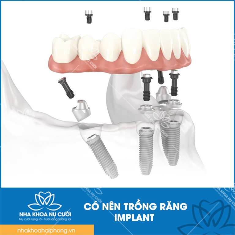 Co-nen-trong-rang-Implant