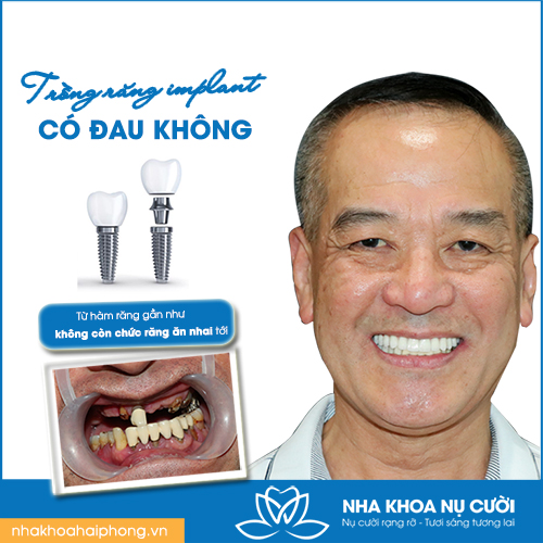 TRỒNG RĂNG IMPLANT CÓ ĐAU KHÔNG ?
