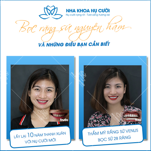 BỌC RĂNG SỨ NGUYÊN HÀM VÀ NHỮNG ĐIỀU BẠN CẦN BIẾT