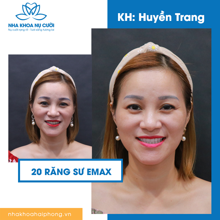 hieu-qua-tot-nhat-tu-boc-rang-su-tham-my