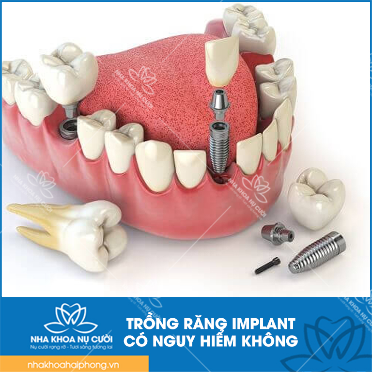 Trong-rang-co-nguy-hiem-khong