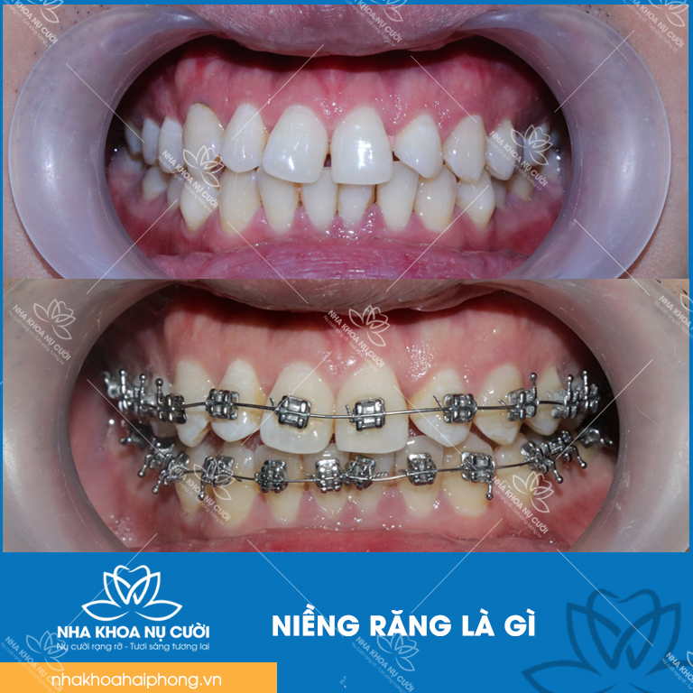 nieng-rang-giai-phap-tot-nhat-cho-ham-rang-deu-dep
