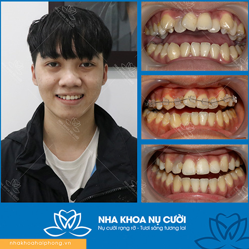 nieng-rang-giai-phap-tot-nhat-cho-ham-rang-deu-dep