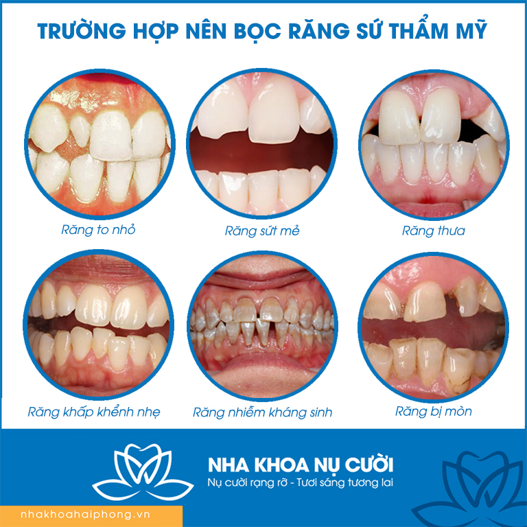 nhung-truong-hop-nen-boc-rang-su