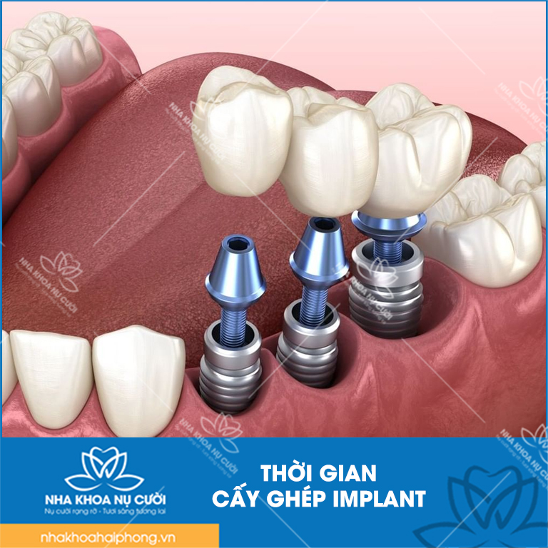 thoi-gian-trong-rang-Implant