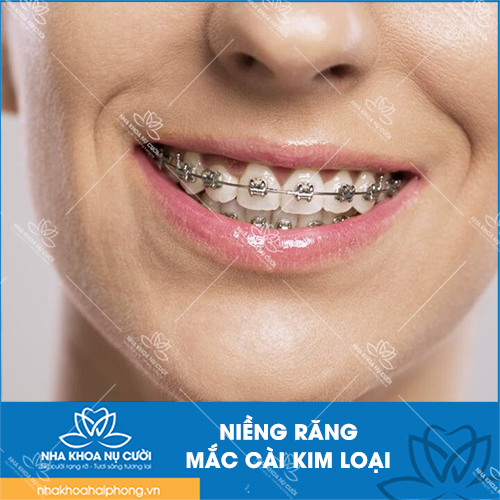 Niềng răng mắc cài kim loại: Ưu điểm, nhược điểm, chi phí và quy trình