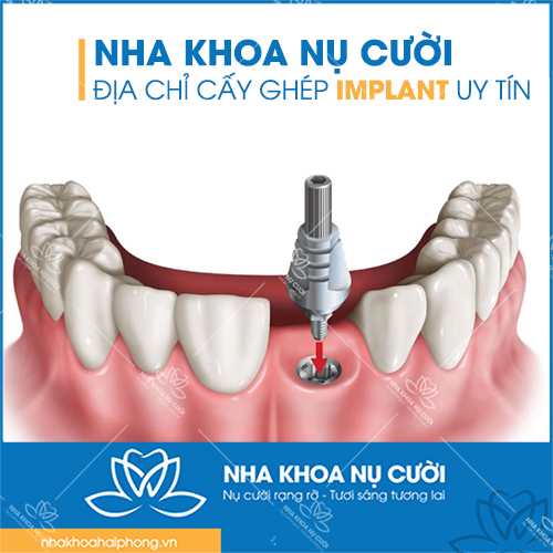 NHA KHOA NỤ CƯỜI– ĐỊA CHỈ CẤY GHÉP IMPLANT UY TÍN