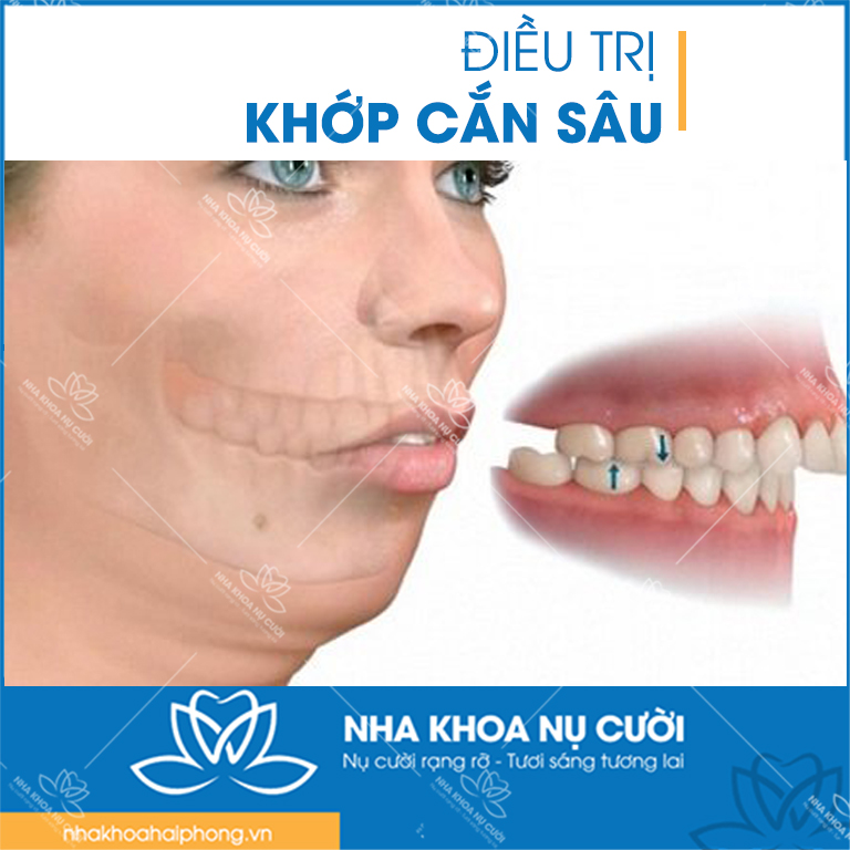 dieu-tri-khop-can-sau