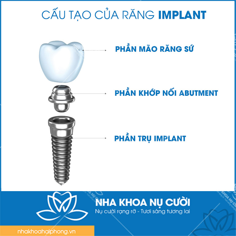 Cau-tao-tru-Implant