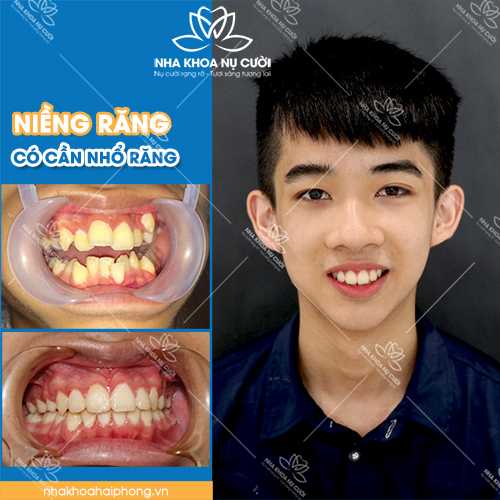 NIỀNG RĂNG CÓ CẦN NHỔ RĂNG KHÔNG