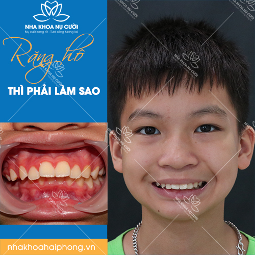 RĂNG HÔ THÌ PHẢI LÀM SAO