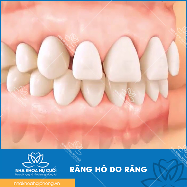 nguyen-nhan-gap-rang-ho