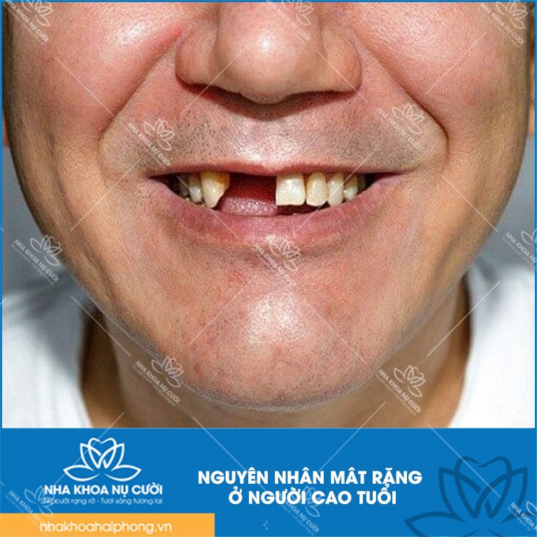 trong-rang-implant-cho-nguoi-cao-tuoi