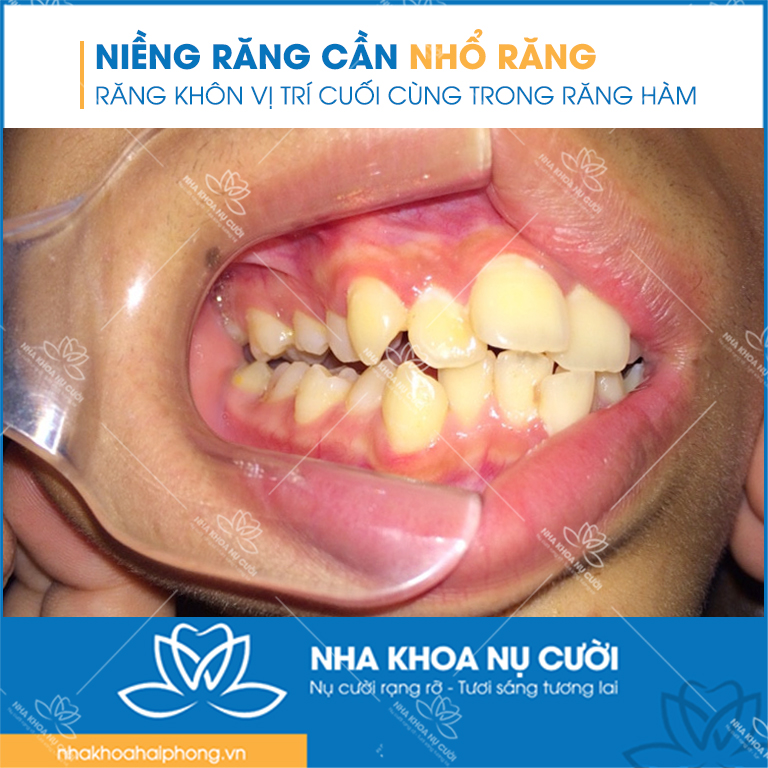 nieng-rang-can-nho-rang