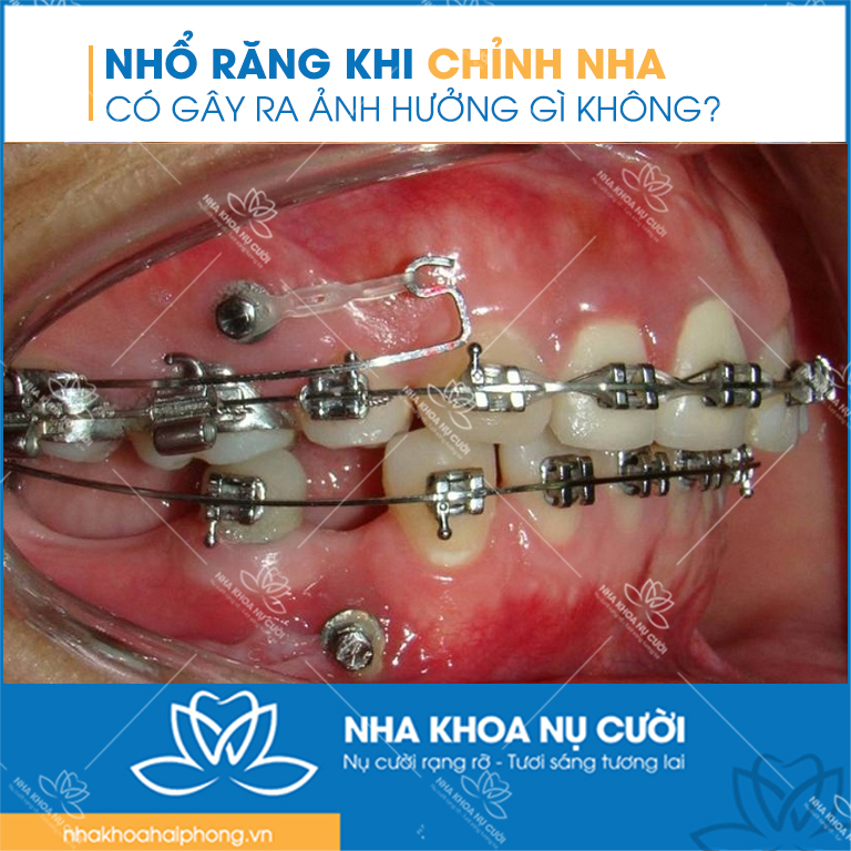 anh-huong-cua-nho-rang-khi-nieng