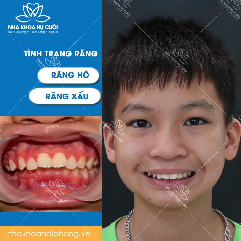 Rang-ho-thi-phai-lam-sao