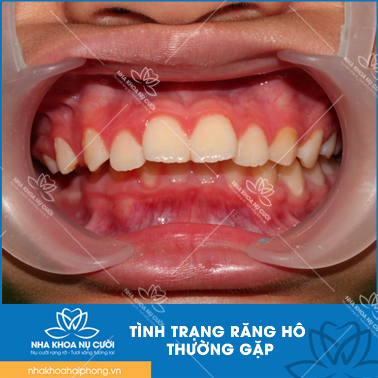 Rang-ho-thi-phai-lam-sao
