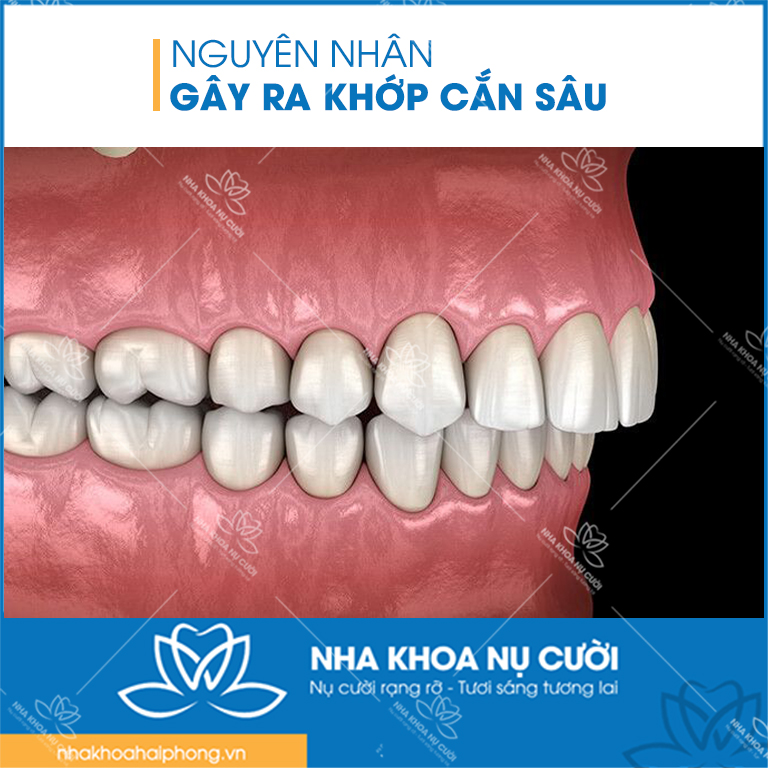 nguyen-nhan-gây-ra-khop-can-sau