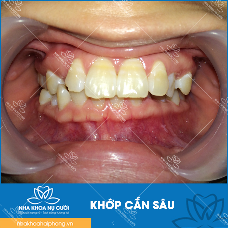 khop-can-sau