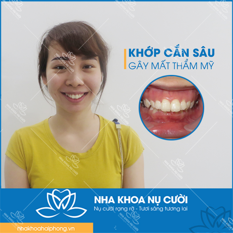 anh-huong-do-khop-can-sau