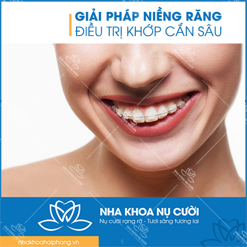 GIẢI PHÁP NIỀNG RĂNG ĐIỀU TRỊ KHỚP CẮN SÂU
