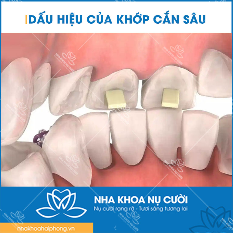 dau-hieu-khop-can-sau