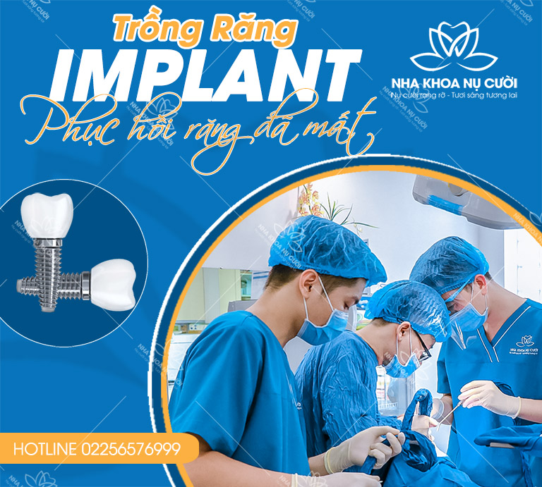 trong-rang-Implant-tại -nha-khoa-nu-cuoi