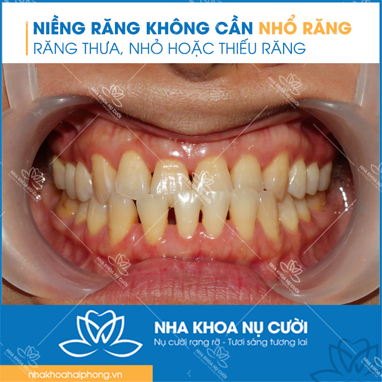 nieng-rang-khong can-nho-rang