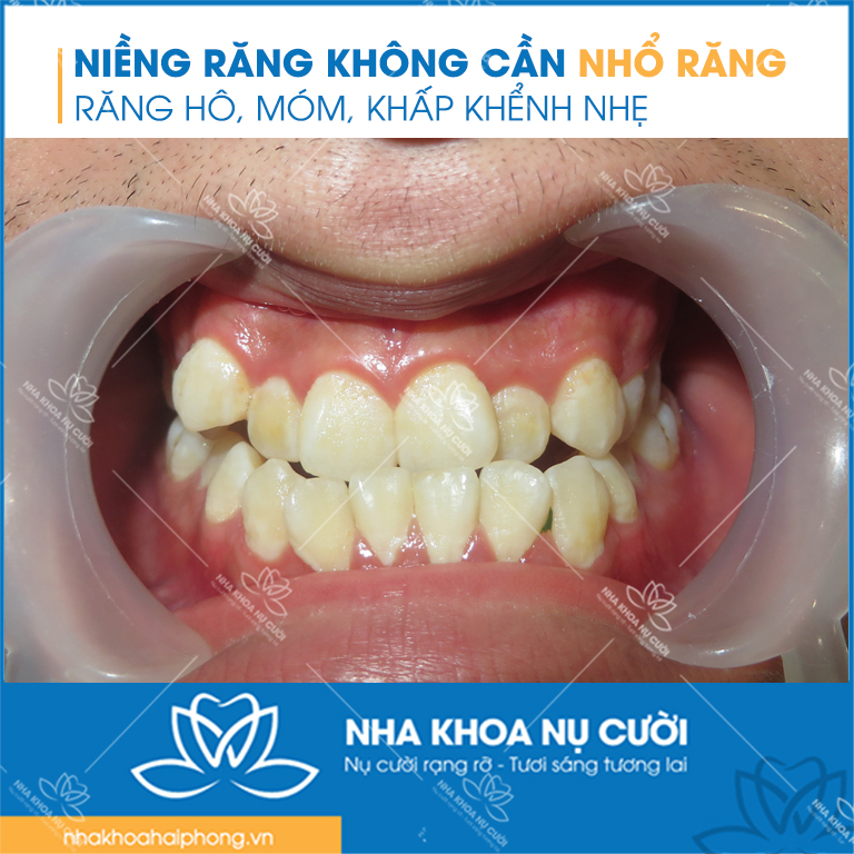 nieng-rang-khong can-nho-rang
