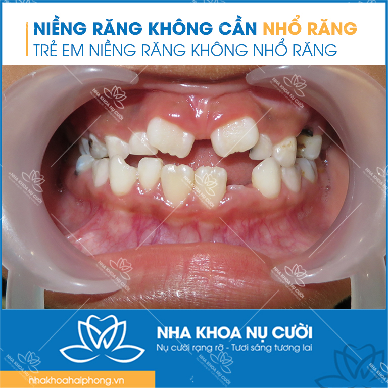 nieng-rang-khong can-nho-rang