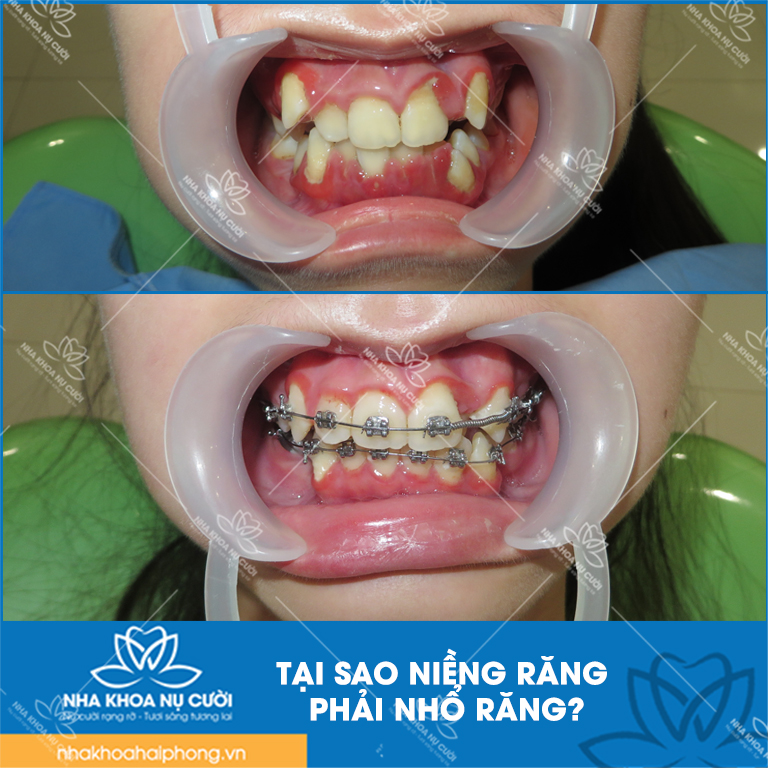 tai-sao-phai-nnho-rang-khi-nieng-rang