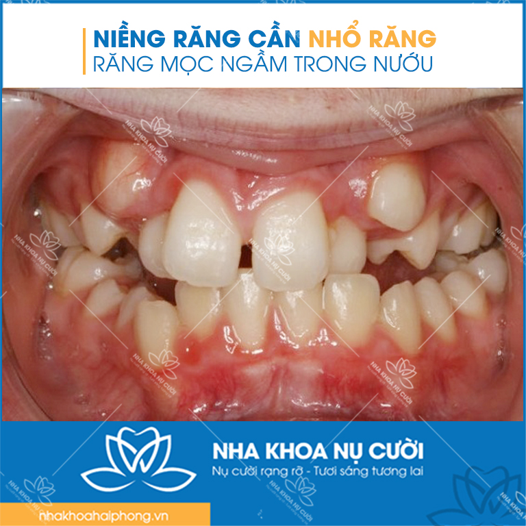 nieng-rang-can-nho-rang