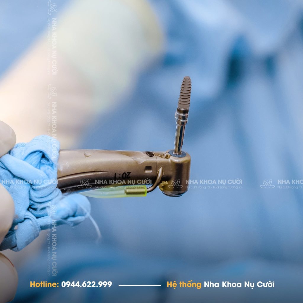 tru-implant-thuy-si