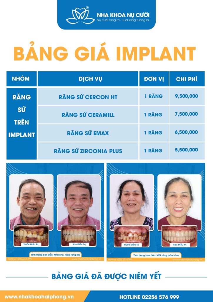 bang-gia-implant