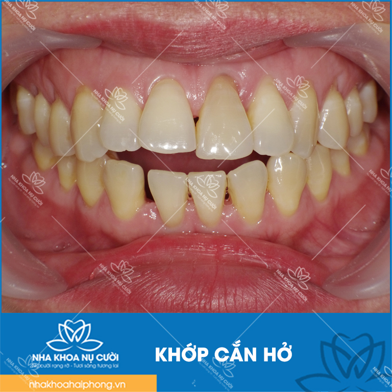 khop-can-ho