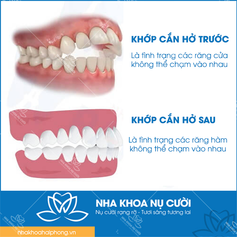 cac-dang-cua-khop-can-ho