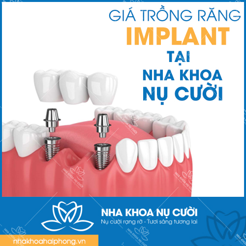 GIÁ TRỒNG RĂNG IMPLANT TẠI HẢI PHÒNG