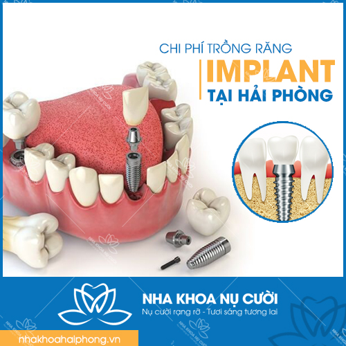 CHI PHÍ TRỒNG RĂNG IMPLANT TẠI HẢI PHÒNG