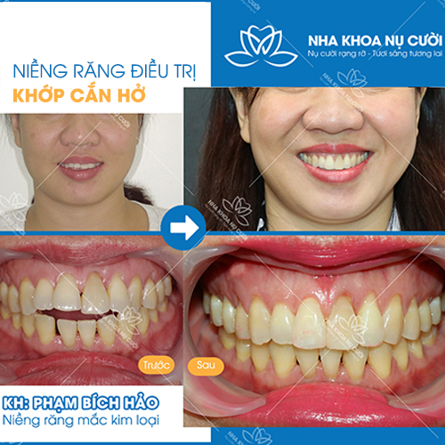 Khớp cắn hở là gì? Nguyên nhân và cách điều trị